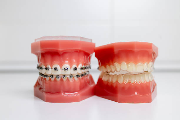 braces and aligners