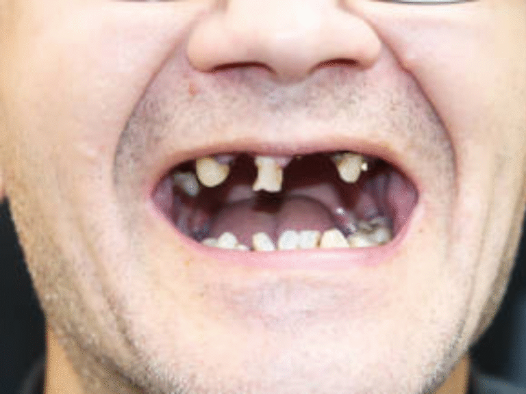 implant