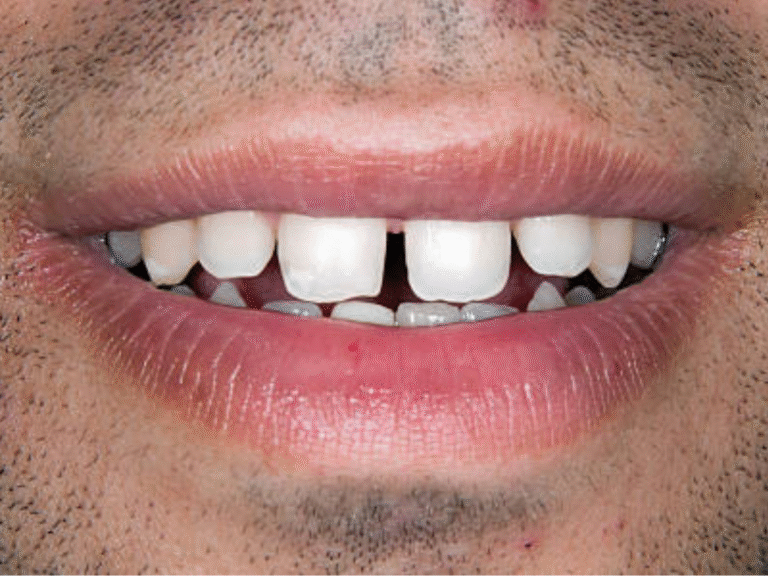 dental veneers
