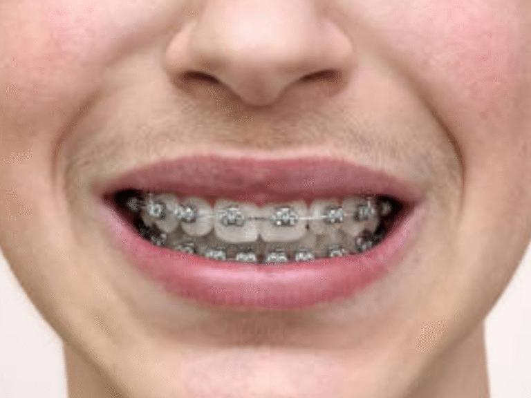 braces