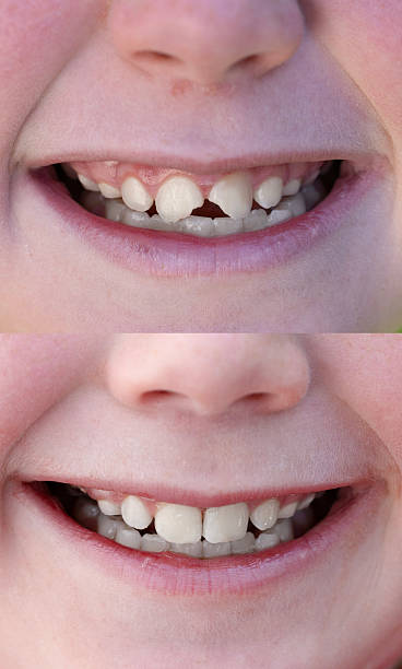dental crown